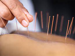 acupuncture in karaikudi